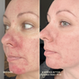Side-by-side photos of a woman's face show red, irritated skin in the before image and noticeably clearer, smoother skin after 4 weeks of using Three Ships Take Five™ Balancing Body + Face Spray - Hypochlorous Acid.