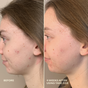 Side-by-side profile photos of a woman’s cheek before and after 4 weeks of using Three Ships Take Five™ Balancing Body + Face Spray - Hypochlorous Acid, showing visible acne reduction in the after image.
